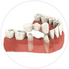 service_prosthodontics_implant