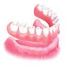 service_prosthodontics_implant