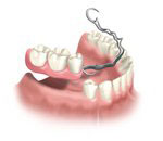 service_prosthodontics_denture
